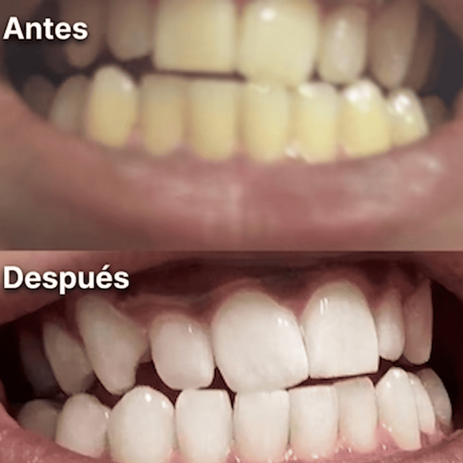 14 Tiras Blanqueadoras Dentales